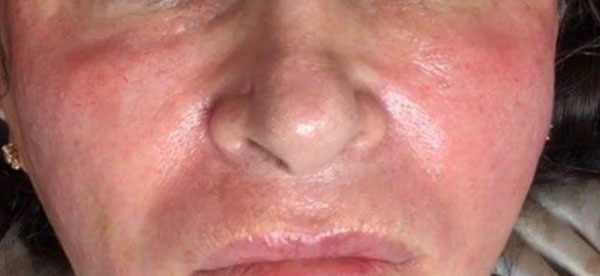 تزریق-فیلر-زیر-چشم-بعد