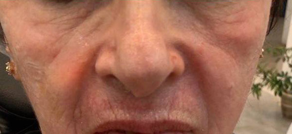 تزریق-فیلر-زیر-چشم-قبل