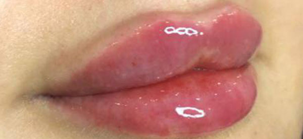 تزریق-فیلر-لب-بعد