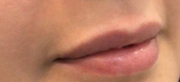 تزریق-فیلر-لب---قبل