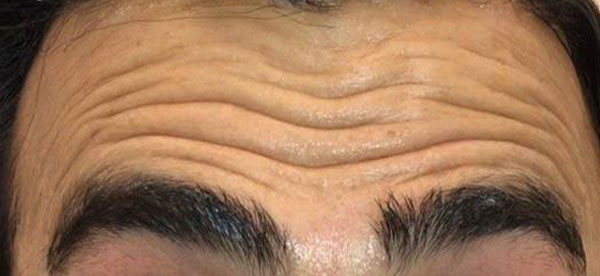 تزریق-لوتاکس---بعد